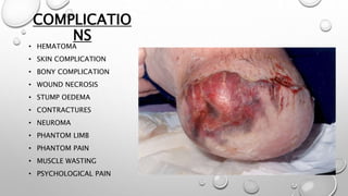 COMPLICATIO
NS
• HEMATOMA
• SKIN COMPLICATION
• BONY COMPLICATION
• WOUND NECROSIS
• STUMP OEDEMA
• CONTRACTURES
• NEUROMA
• PHANTOM LIMB
• PHANTOM PAIN
• MUSCLE WASTING
• PSYCHOLOGICAL PAIN
 