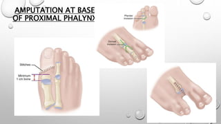 AMPUTATION AT BASE
OF PROXIMAL PHALYNX
 