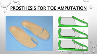 PROSTHESIS FOR TOE AMPUTATION
 