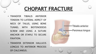 CHOPART FRACTURE
• TRANSFER TIBIALIS ANTERIOR
TENDON TO LATERAL ASPECT OF
NECK OF TALUS, USING BONE
TUNNEL WITH BIOTENODESIS
SCREW AND USING A SUTURE
ANCHOR OR STAPLE TO SECURE
FIXATION.
• TRANSFER EXTENSOR HALLUCIS
LONGUS TO ANTERIOR PROCESS
OF CALCANEUS.
 