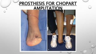 PROSTHESIS FOR CHOPART
AMPUTATION
 