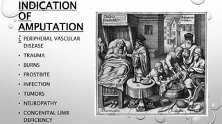 INDICATION
OF
AMPUTATION
:• PERIPHERAL VASCULAR
DISEASE
• TRAUMA
• BURNS
• FROSTBITE
• INFECTION
• TUMORS
• NEUROPATHY
• CONGENITAL LIMB
DEFICIENCY
 
