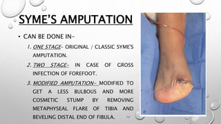 SYME’S AMPUTATION
• CAN BE DONE IN-
1. ONE STAGE- ORIGINAL / CLASSIC SYME'S
AMPUTATION.
2. TWO STAGE- IN CASE OF GROSS
INFECTION OF FOREFOOT.
3. MODIFIED AMPUTATION- MODIFIED TO
GET A LESS BULBOUS AND MORE
COSMETIC STUMP BY REMOVING
METAPHYSEAL FLARE OF TIBIA AND
BEVELING DISTAL END OF FIBULA.
 