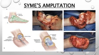 SYME’S AMPUTATION
 