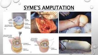 SYME’S AMPUTATION
 