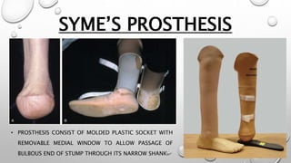 SYME’S PROSTHESIS
• PROSTHESIS CONSIST OF MOLDED PLASTIC SOCKET WITH
REMOVABLE MEDIAL WINDOW TO ALLOW PASSAGE OF
BULBOUS END OF STUMP THROUGH ITS NARROW SHANK.
 