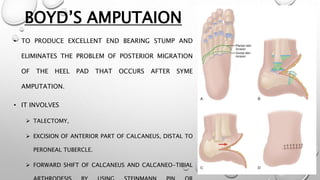 BOYD’S AMPUTAION
• TO PRODUCE EXCELLENT END BEARING STUMP AND
ELIMINATES THE PROBLEM OF POSTERIOR MIGRATION
OF THE HEEL PAD THAT OCCURS AFTER SYME
AMPUTATION.
• IT INVOLVES
 TALECTOMY,
 EXCISION OF ANTERIOR PART OF CALCANEUS, DISTAL TO
PERONEAL TUBERCLE.
 FORWARD SHIFT OF CALCANEUS AND CALCANEO-TIBIAL
 