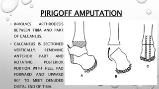 PIRIGOFF AMPUTATION
• INVOLVES ARTHRODESIS
BETWEEN TIBIA AND PART
OF CALCANEUS.
• CALCANEUS IS SECTIONED
VERTICALLY, REMOVING
ANTERIOR PART AND
ROTATING POSTERIOR
PORTION WITH HEEL PAD
FORWARD AND UPWARD
90* TO MEET DENUDED
DISTAL END OF TIBIA.
 