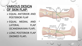 VARIOUS DESIGN
OF SKIN FLAP:
 EQUAL ANTERIOR AND
POSTERIOR FLAP
 EQUAL MEDIAL AND
LATERAL FLAP
(SCANDINAVIAN FLAP).
 LONG POSTERIOR FLAP
(SKEWED FLAP).
 