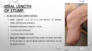 IDEAL LENGTH
OF STUMP:
• IN BELOW KNEE AMPUTATION-
 IDEAL LENGTH 12.5 TO 17.5 CM DISTAL TO MEDIAL
TIBIAL ARTICULAR SURFACE.
 MINIMUM WORKING LENGTH -9 CM
 <12 CM LESS EFFICIENT
 <6 CM DO NOT FUNCTION
 RULE OF THUMB FOR SELECTING LEVEL OF BONE SECTION
IS TO ALLOW 2.5 CM OF BONE LENGTH FOR EACH 30 CM
OF BODY HEIGHT.
 