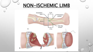 NON-ISCHEMIC LIMB
 