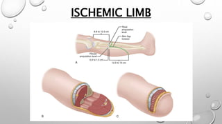 ISCHEMIC LIMB
 