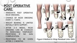 POST OPERATIVE
CARE:
• IMMEDIATE POST OPERATIVE
RIGID DRESSING.
• CHANGE OF RIGID DRESSING
EVERY 5-7 DAYS.
• WEIGHT BEARING IS LIMITED
INITIALLY WITH SUPPORT.
• AFTER 3-4 WEEKS, RIGID
DRESSING CAN BE CHANGED
TO REMOVABLE TEMPORARY
PROSTHESIS IF NO SKIN
COMPLICATION.
• PROSTHESIS TO BE GIVEN
AFTER 2-3 MONTHS.
 