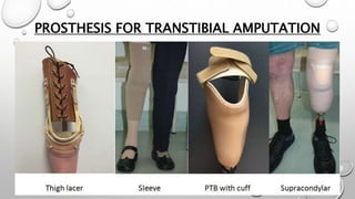 PROSTHESIS FOR TRANSTIBIAL AMPUTATION
 
