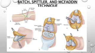 BATCH, SPITTLER, AND MCFADDIN
TECHNIQUE
 