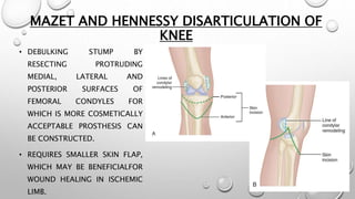 MAZET AND HENNESSY DISARTICULATION OF
KNEE
• DEBULKING STUMP BY
RESECTING PROTRUDING
MEDIAL, LATERAL AND
POSTERIOR SURFACES OF
FEMORAL CONDYLES FOR
WHICH IS MORE COSMETICALLY
ACCEPTABLE PROSTHESIS CAN
BE CONSTRUCTED.
• REQUIRES SMALLER SKIN FLAP,
WHICH MAY BE BENEFICIALFOR
WOUND HEALING IN ISCHEMIC
LIMB.
 