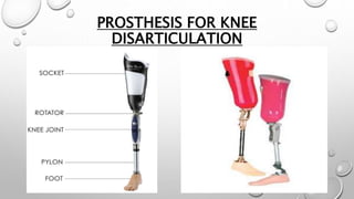 PROSTHESIS FOR KNEE
DISARTICULATION
 