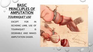 BASIC
PRINCLIPLES OF
AMPUTATION
TOURNIQUET USE:
EXCEPT FOR IN
ISCHEMIC LIMB, USE OF
TOURNIQUET IS
DESIRABLE AND MAKES
AMPUTATION EASIER.
 