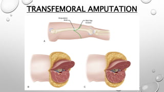 TRANSFEMORAL AMPUTATION
 