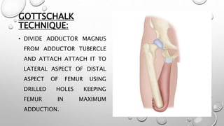 GOTTSCHALK
TECHNIQUE:
• DIVIDE ADDUCTOR MAGNUS
FROM ADDUCTOR TUBERCLE
AND ATTACH ATTACH IT TO
LATERAL ASPECT OF DISTAL
ASPECT OF FEMUR USING
DRILLED HOLES KEEPING
FEMUR IN MAXIMUM
ADDUCTION.
 