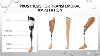 PROSTHESIS FOR TRANSFEMORAL
AMPUTATION
 