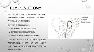 HEMIPELVECTOMY
• IN CONTRAST TO HIP DISARTICULATION,
HEMIPELVECTOMY REMOVE INGUINAL
AND ILIAC LYMPH NODE.
• DIFFERENT TECHNIQUES:
 STANDARD HEMIPELVECTOMY
 EXTENDED HEMIPELVECTOMY
 CONSERVATIVE HEMIPELVECTOMY
• GORDON-TAYLOR CALLED HINDQUATER
AMPUTATION “ ONE OF THE MOST
COLLOSAL MUTILATIONS PRACTICED ON
HUMAN FRAME.”
 