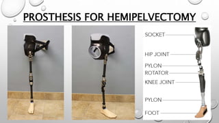 PROSTHESIS FOR HEMIPELVECTOMY
 