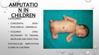 AMPUTATIO
N IN
CHILDRENCATEGORIES-
• CONGENITAL (60%)-
PHACOMELIA , HEMIMELIA.
• ACQUIRED (40%)-
SECONDARY TO TRAUMA,
NEOPLASM AND INFECTION.
DYSVASCULAR AMPUTATION
IS RARE IN CHILDREN.
 