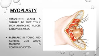 MYOPLASTY
• TRANSECTED MUSCLE IS
SUTURED TO SOFT TISSUE
SUCH ASOPPOSING MUSCLE
GROUP OR FASCIA.
• PREFERRED IN YOUNG AND
ISCHEMIC LIMB WHERE
MYODESIS IS
CONTRAINDICATED.
 