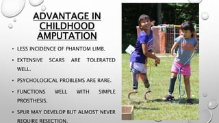 ADVANTAGE IN
CHILDHOOD
AMPUTATION
• LESS INCIDENCE OF PHANTOM LIMB.
• EXTENSIVE SCARS ARE TOLERATED
WELL.
• PSYCHOLOGICAL PROBLEMS ARE RARE.
• FUNCTIONS WELL WITH SIMPLE
PROSTHESIS.
• SPUR MAY DEVELOP BUT ALMOST NEVER
REQUIRE RESECTION.
 