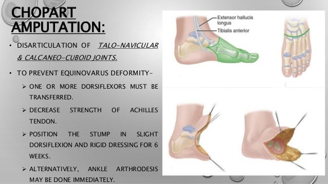 Lower limb amputation