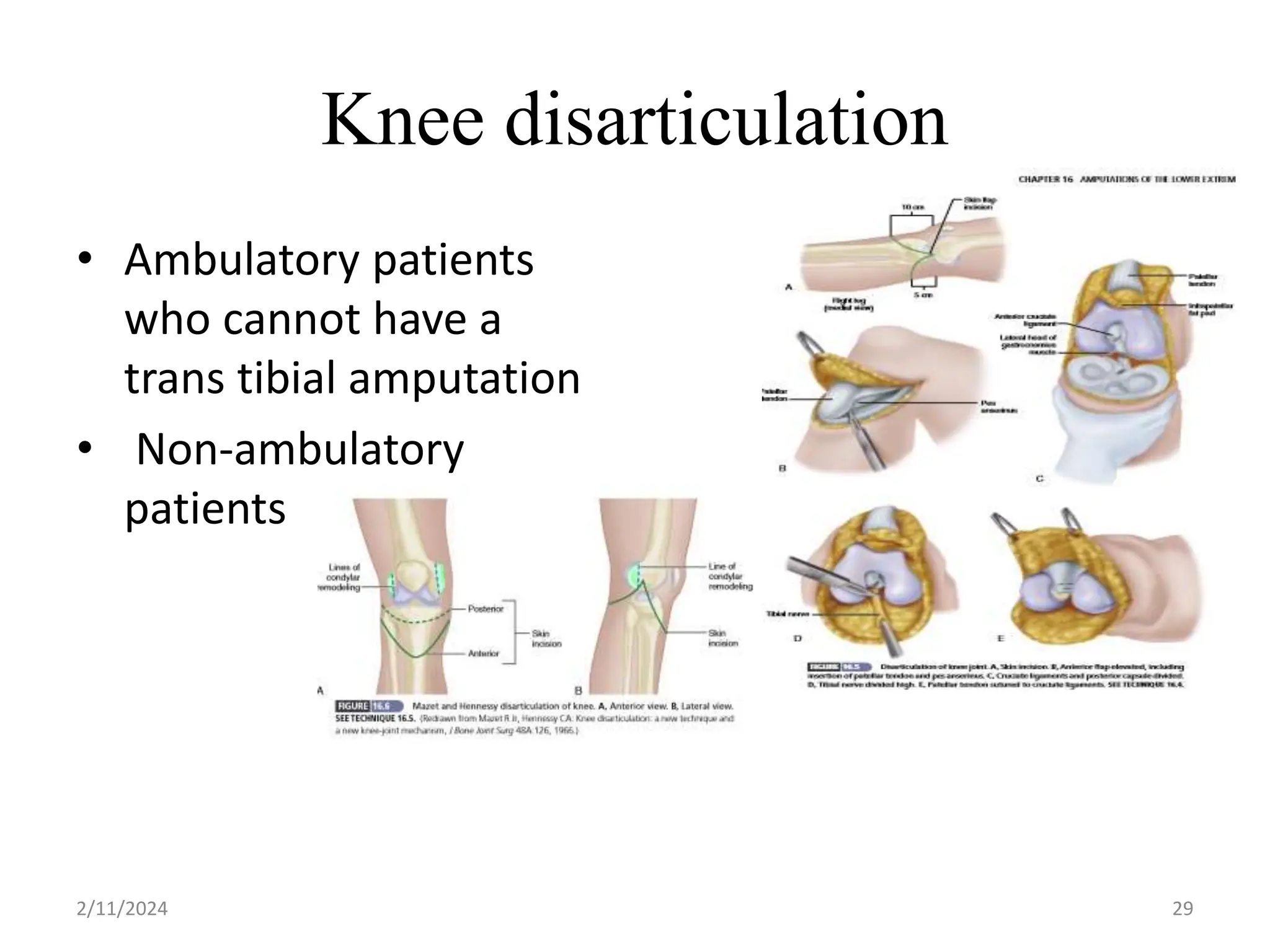 Lower limb amputation pptx injuries diseases and conditions