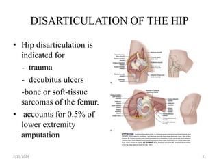 DISARTICULATION OF THE HIP
• Hip disarticulation is
indicated for
- trauma
- decubitus ulcers
-bone or soft-tissue
sarcomas of the femur.
• accounts for 0.5% of
lower extremity
amputation
2/11/2024 31
 