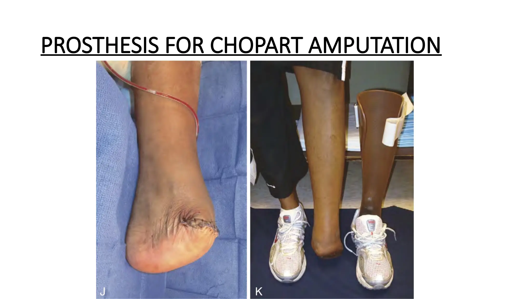 LOWER LIMB AMPUTATION SO much for [1].pptx