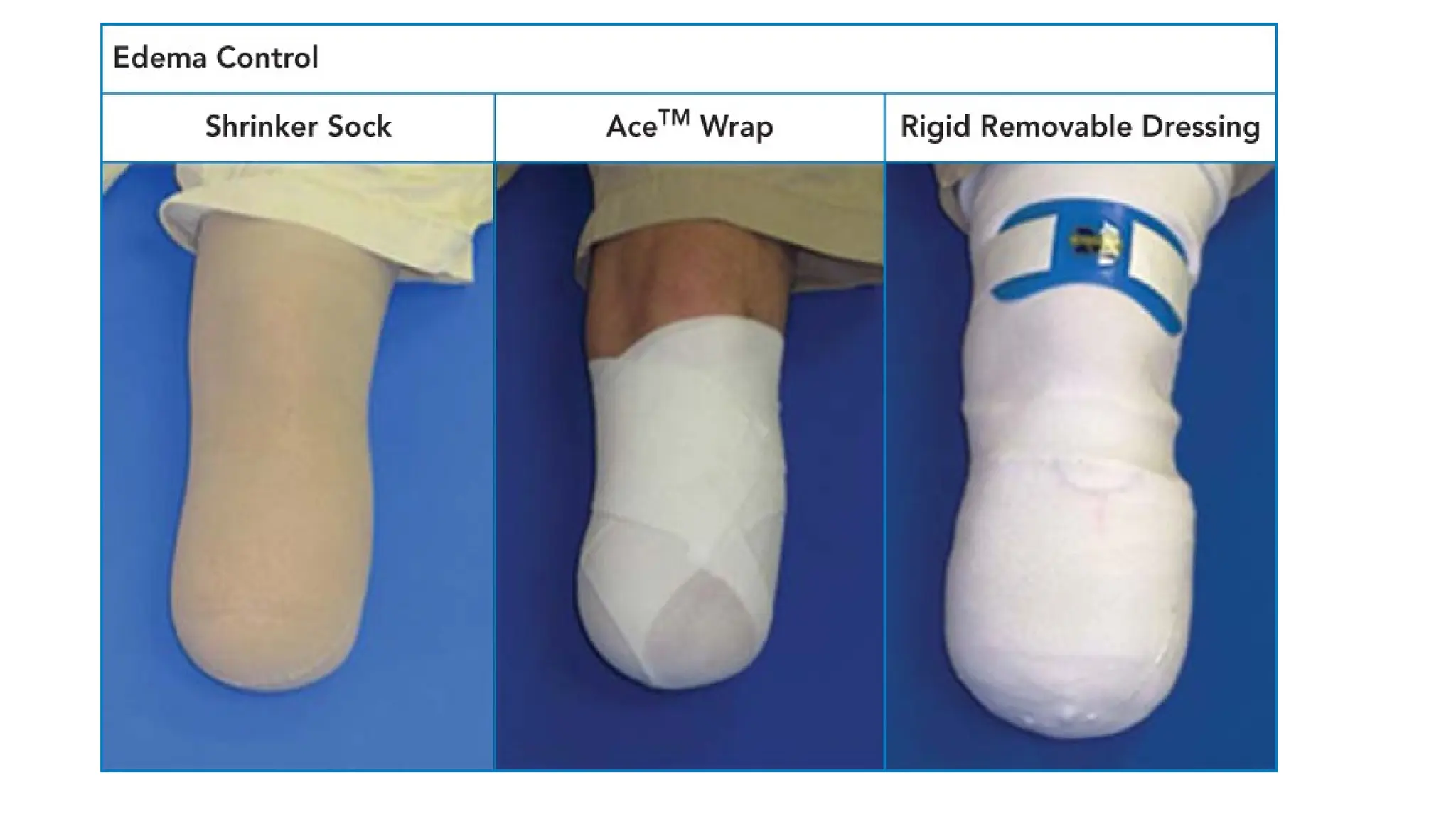 LOWER LIMB AMPUTATION Amputation is the surgical removal of a limb or ...