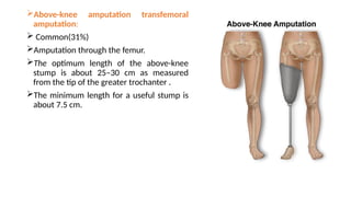 Above-knee amputation transfemoral
amputation:
 Common(31%)
Amputation through the femur.
The optimum length of the above-knee
stump is about 25–30 cm as measured
from the tip of the greater trochanter .
The minimum length for a useful stump is
about 7.5 cm.
 