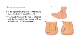 Syme’s amputation
• In this operation, the tibia and fibula are
divided just above the ankle joint.
• The intact skin over the heel is attached
back to the end of the stump with or
without a part of the calcaneum .
 
