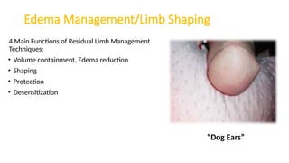 Edema Management/Limb Shaping
4 Main Functions of Residual Limb Management
Techniques:
• Volume containment, Edema reduction
• Shaping
• Protection
• Desensitization
“Dog Ears”
 