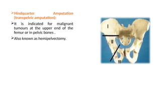 Hindquarter Amputation
(transpelvic amputation):
It is indicated for malignant
tumours at the upper end of the
femur or in pelvic bones .
Also known as hemipelvectomy.
 