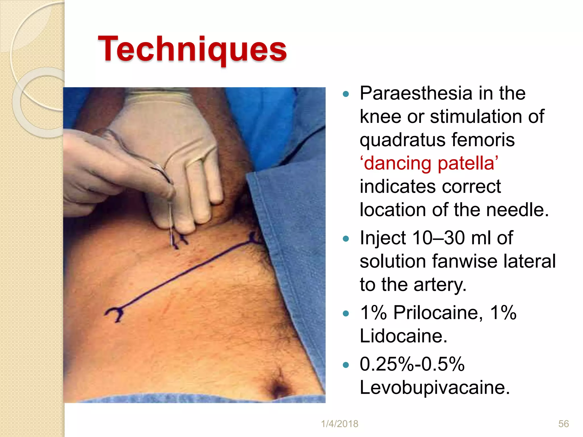 Techniques
 Paraesthesia in the
knee or stimulation of
quadratus femoris
‘dancing patella’
indicates correct
location of the needle.
 Inject 10–30 ml of
solution fanwise lateral
to the artery.
 1% Prilocaine, 1%
Lidocaine.
 0.25%-0.5%
Levobupivacaine.
1/4/2018 56
 