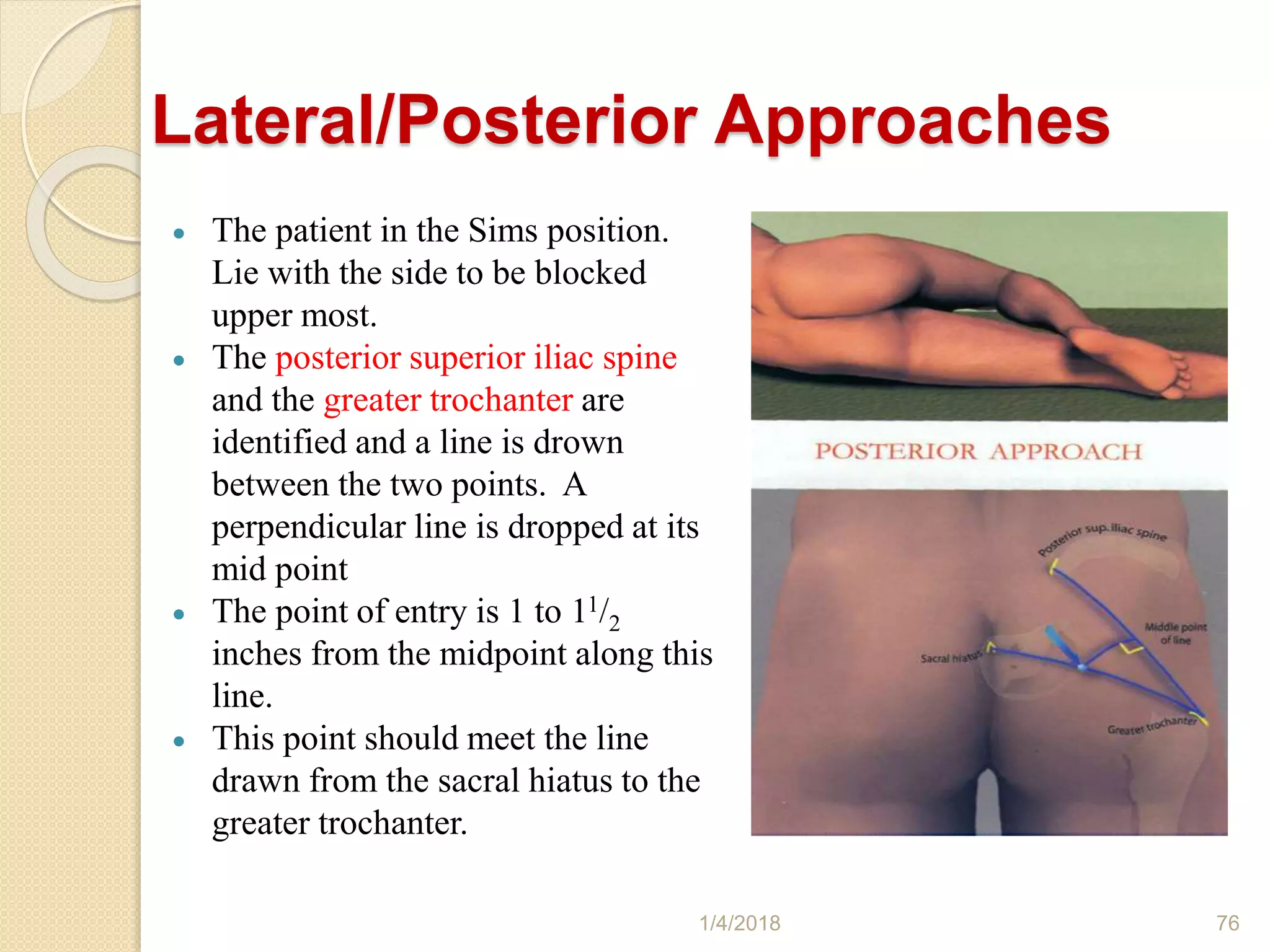 Lateral/Posterior Approaches
 The patient in the Sims position.
Lie with the side to be blocked
upper most.
 The posterior superior iliac spine
and the greater trochanter are
identified and a line is drown
between the two points. A
perpendicular line is dropped at its
mid point
 The point of entry is 1 to 11/2
inches from the midpoint along this
line.
 This point should meet the line
drawn from the sacral hiatus to the
greater trochanter.
1/4/2018 76
 