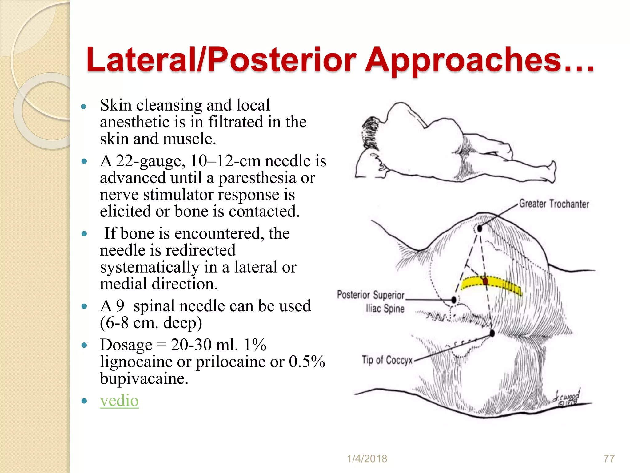  Skin cleansing and local
anesthetic is in filtrated in the
skin and muscle.
 A 22-gauge, 10–12-cm needle is
advanced until a paresthesia or
nerve stimulator response is
elicited or bone is contacted.
 If bone is encountered, the
needle is redirected
systematically in a lateral or
medial direction.
 A 9 spinal needle can be used
(6-8 cm. deep)
 Dosage = 20-30 ml. 1%
lignocaine or prilocaine or 0.5%
bupivacaine.
 vedio
1/4/2018 77
Lateral/Posterior Approaches…
 