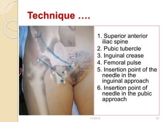 Technique ….
1. Superior anterior
iliac spine
2. Pubic tubercle
3. Inguinal crease
4. Femoral pulse
5. Insertion point of the
needle in the
inguinal approach
6. Insertion point of
needle in the pubic
approach
1/4/2018 62
 
