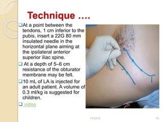 Technique ….
At a point between the
tendons, 1 cm inferior to the
pubis, insert a 22G 80 mm
insulated needle in the
horizontal plane aiming at
the ipsilateral anterior
superior iliac spine.
 At a depth of 5–6 cm
resistance of the obturator
membrane may be felt.
10 mL of LA is injected for
an adult patient. A volume of
0.3 ml/kg is suggested for
children.
 video
1/4/2018 63
 