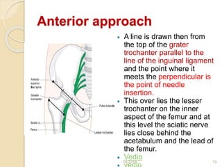 Anterior approach
 A line is drawn then from
the top of the grater
trochanter parallel to the
line of the inguinal ligament
and the point where it
meets the perpendicular is
the point of needle
insertion.
 This over lies the lesser
trochanter on the inner
aspect of the femur and at
this level the sciatic nerve
lies close behind the
acetabulum and the lead of
the femur.
 Vedio
1/4/2018 79
 