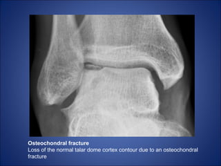 Talar Cortex Lower limb fractures | PPT