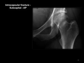 Intracapsular fracture -
Subcapital - AP
10
 