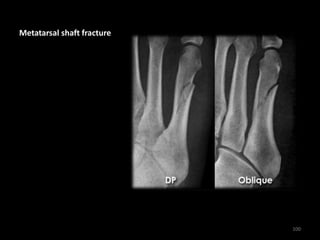 Metatarsal shaft fracture
100
 
