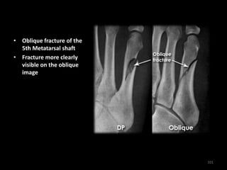 • Oblique fracture of the
5th Metatarsal shaft
• Fracture more clearly
visible on the oblique
image
101
 