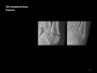 5th metatarsal base
fracture
102
 
